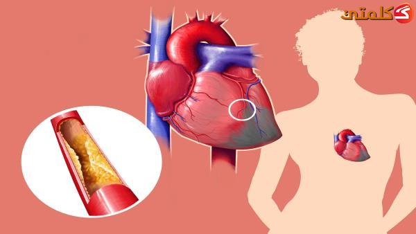 كيف تختلف الأزمة القلبية عند النساء عن الرجال؟