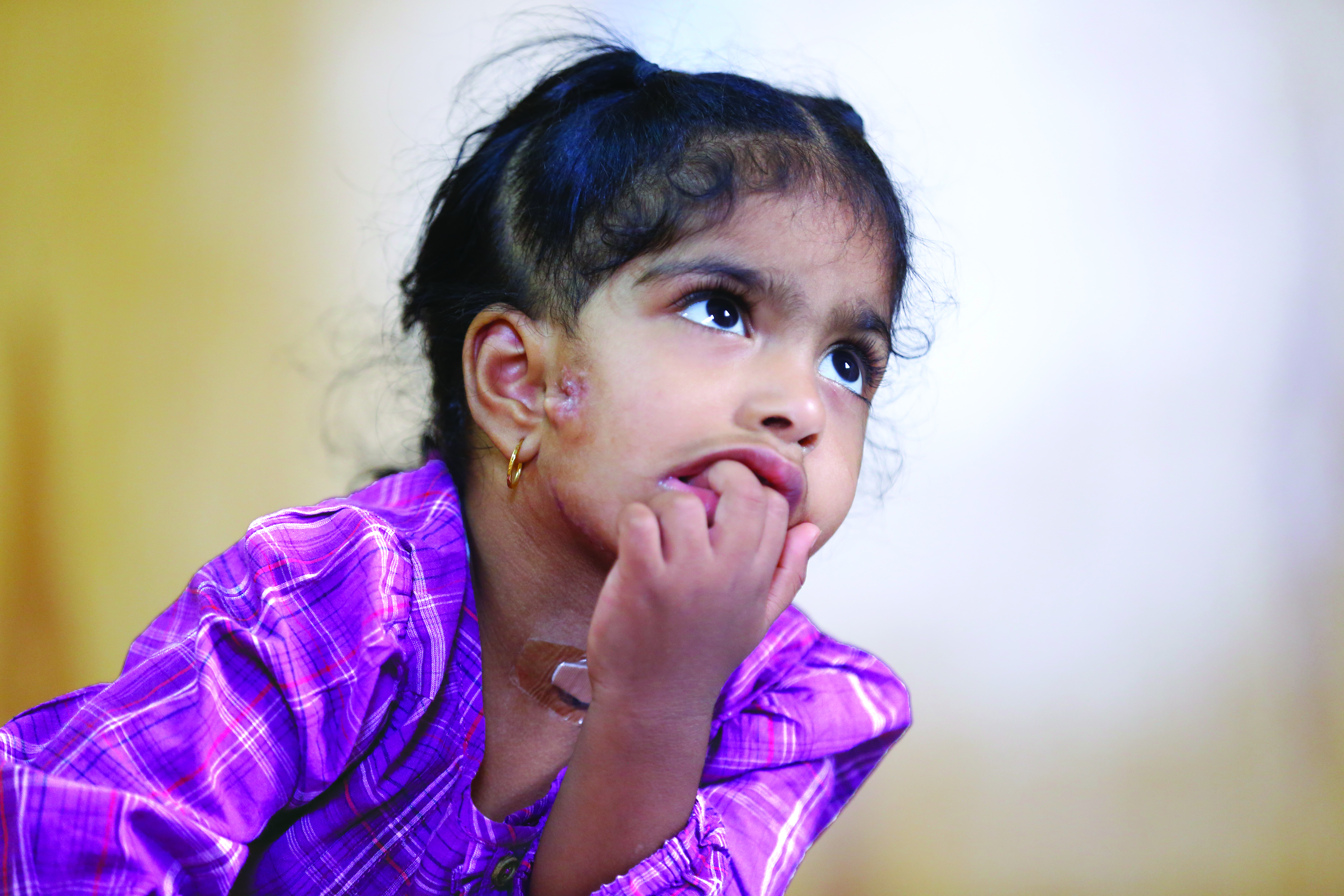 Omani girl undergoes surgery in India for rare congenital disorder