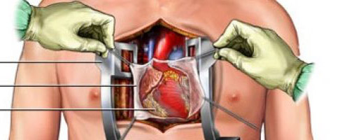 صمام قلب متطور يعطى بارقة أمل جديدة لأمراض القلب الروماتيزمية
