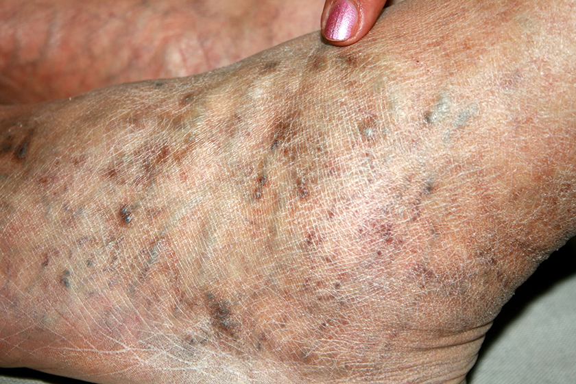 Care contacteaza cu varicoza, Venele varicoase pe picioarele metodelor de tratament