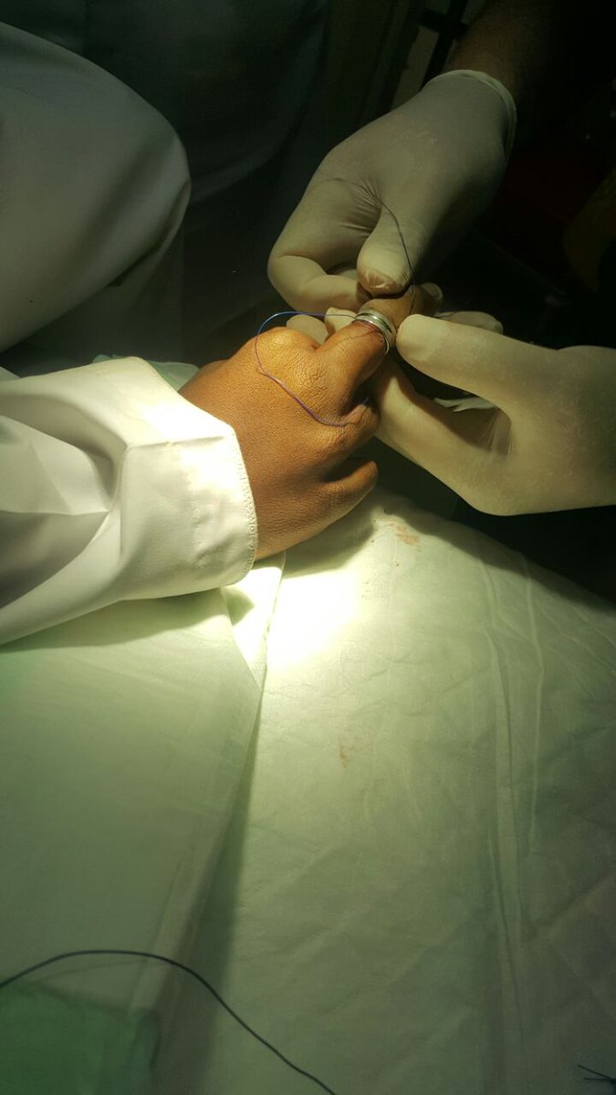 تحرير إصبع طفل من خاتم حديدي علق فيه
