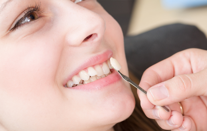 Oman wellness: Give your smile an upgrade with dental veneers