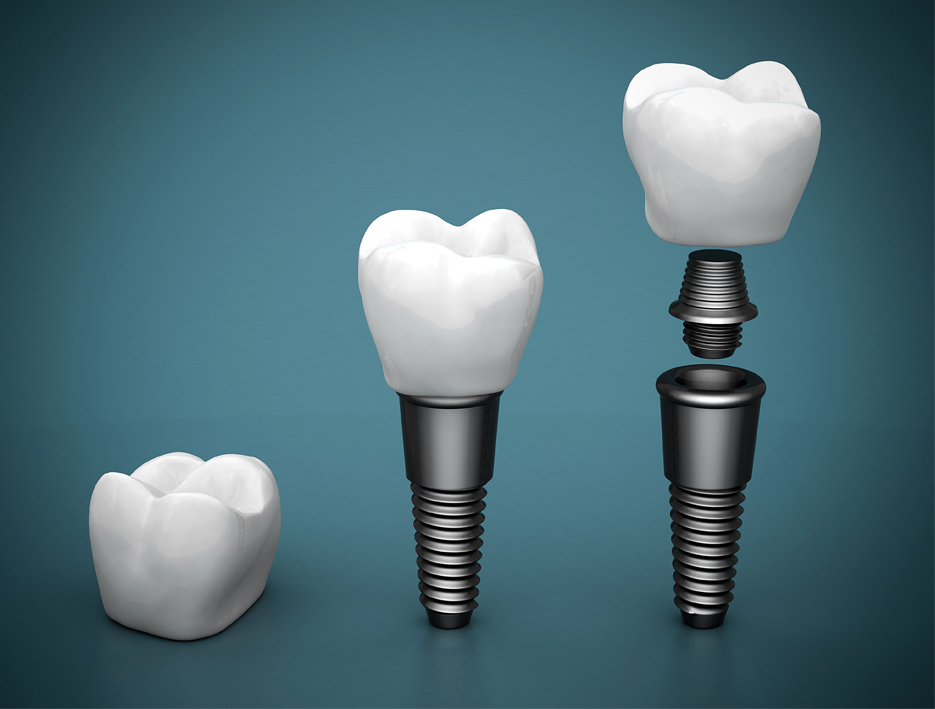 Oman wellness: Dental implants, the best solution for your missing teeth