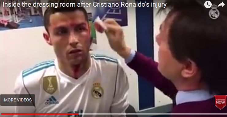 بالفيديو.. تورم عين رونالدو يمنعه من مواجهة ليجانيس
