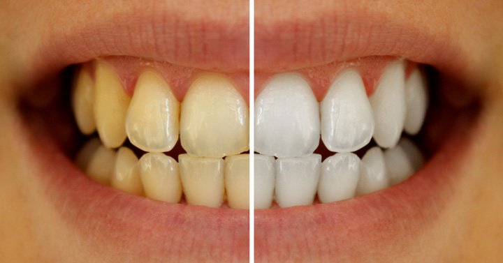 تخلص من مشكلة إصفرار الأسنان بهذه الخطوات
