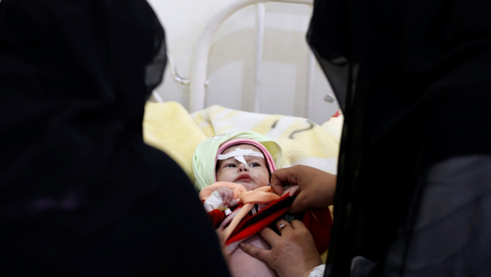 Yemen hospital struggles with number of malnourished children