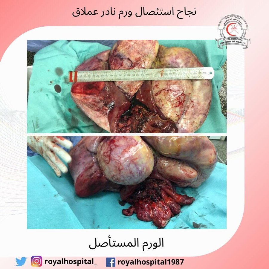 نجاح استئصال ورم نادر عملاق في المستشفى السلطاني
