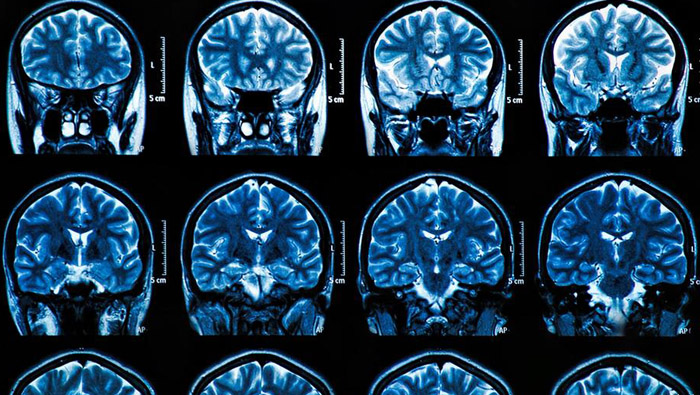 Severe brain damage possible even with mild coronavirus symptoms