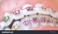 أزدهار عمليات تجميل الأسنان بالعيادات الخاصة