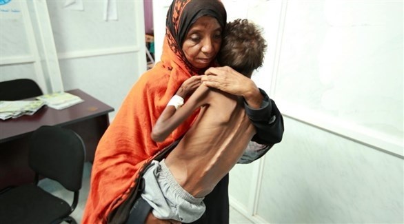 ارتفاع معدلات سوء التغذية الحاد بين الأطفال في اليمن