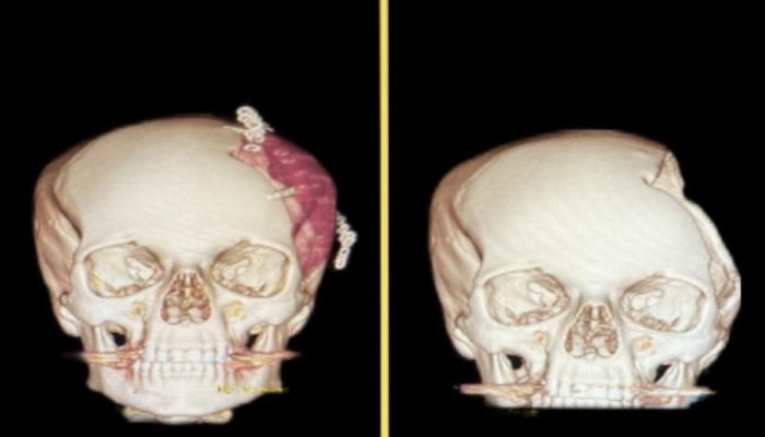 عبر مواد مُركبة بصناعة محلية.. مستشفى خولة ينجح في إجراء ترميم وزراعة جمجمة لمريض