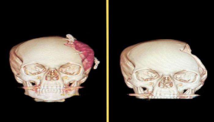 Medical team restores patient’s skull in Oman