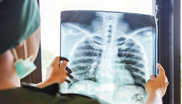 دراسة تكشف سبب عدم إصابة معظم المدخنين بسرطان الرئة