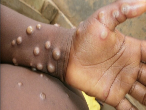 Canada confirms 168 cases of monkeypox