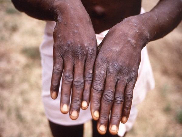 Monkeypox cases in Britain pass 1,000, world total now 3,413