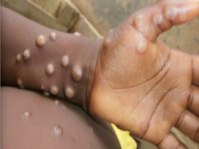 Monkeypox hits Europe, Americas hardest: WHO