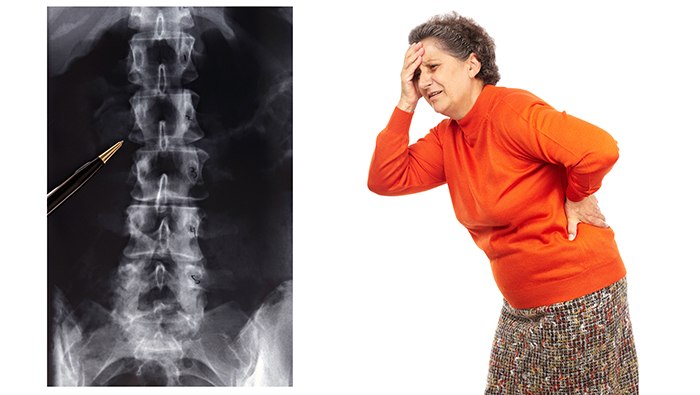 Testing for osteoporosis: Assessing your risk for bone breaks