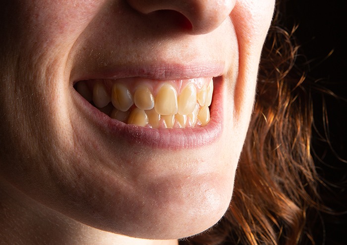 Notice yellow teeth? Might not be what you think