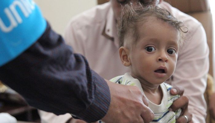 الأمم المتحدة: أكثر من مليوني طفل يعانون من سوء تغذية حاد في اليمن