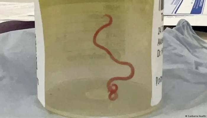 Live parasitic worm plucked from Australian woman's brain