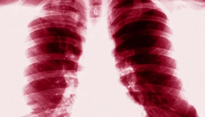 Tuberculosis: First time infections rise to 30-year high