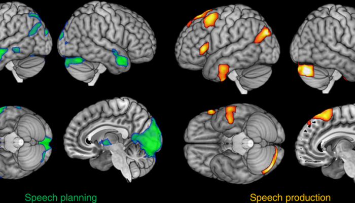 Pre-surgery brain recordings unveil speech planning process: Study
