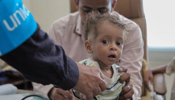 اليونيسف: ملايين الأطفال في اليمن يعانون سوء التغذية