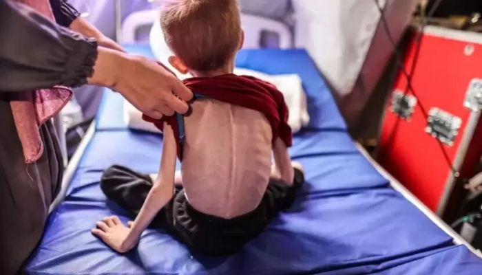 326 وفاة بسبب سوء التغذية ونقص الدواء خلال 80 يومًا من الحصار في غزة