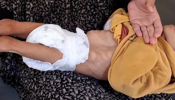 غزة: ارتفاع حصيلة شهداء التجويع إلى 266 شخصاً بينهم 112 طفلاً